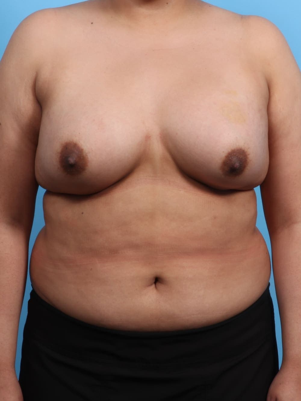 Breast Augmentation case #3203 after, image 1