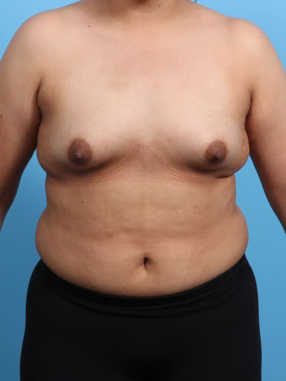 Breast Augmentation case #3203 before, image 1