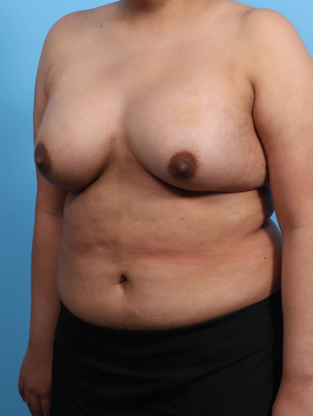 Breast Augmentation case #3203 after, image 2