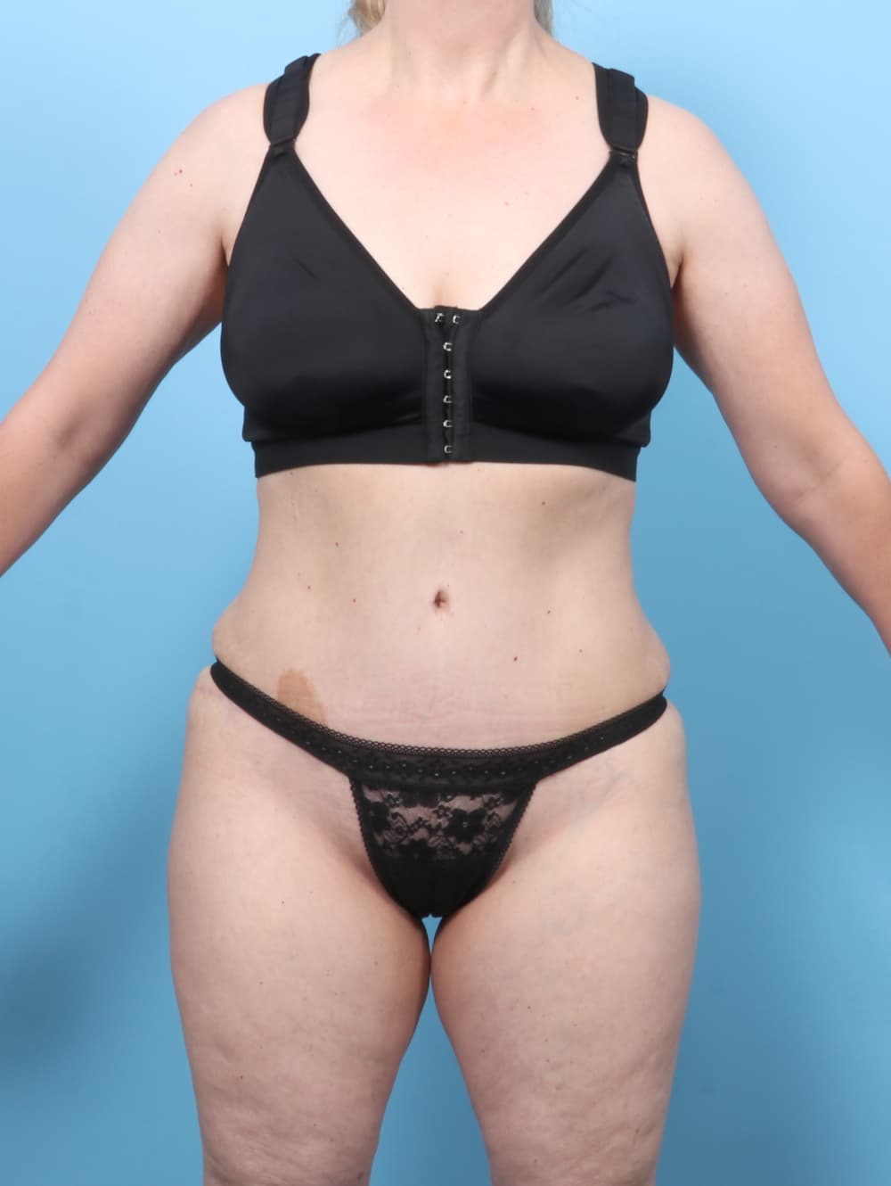 Tummy Tuck case #8634 after