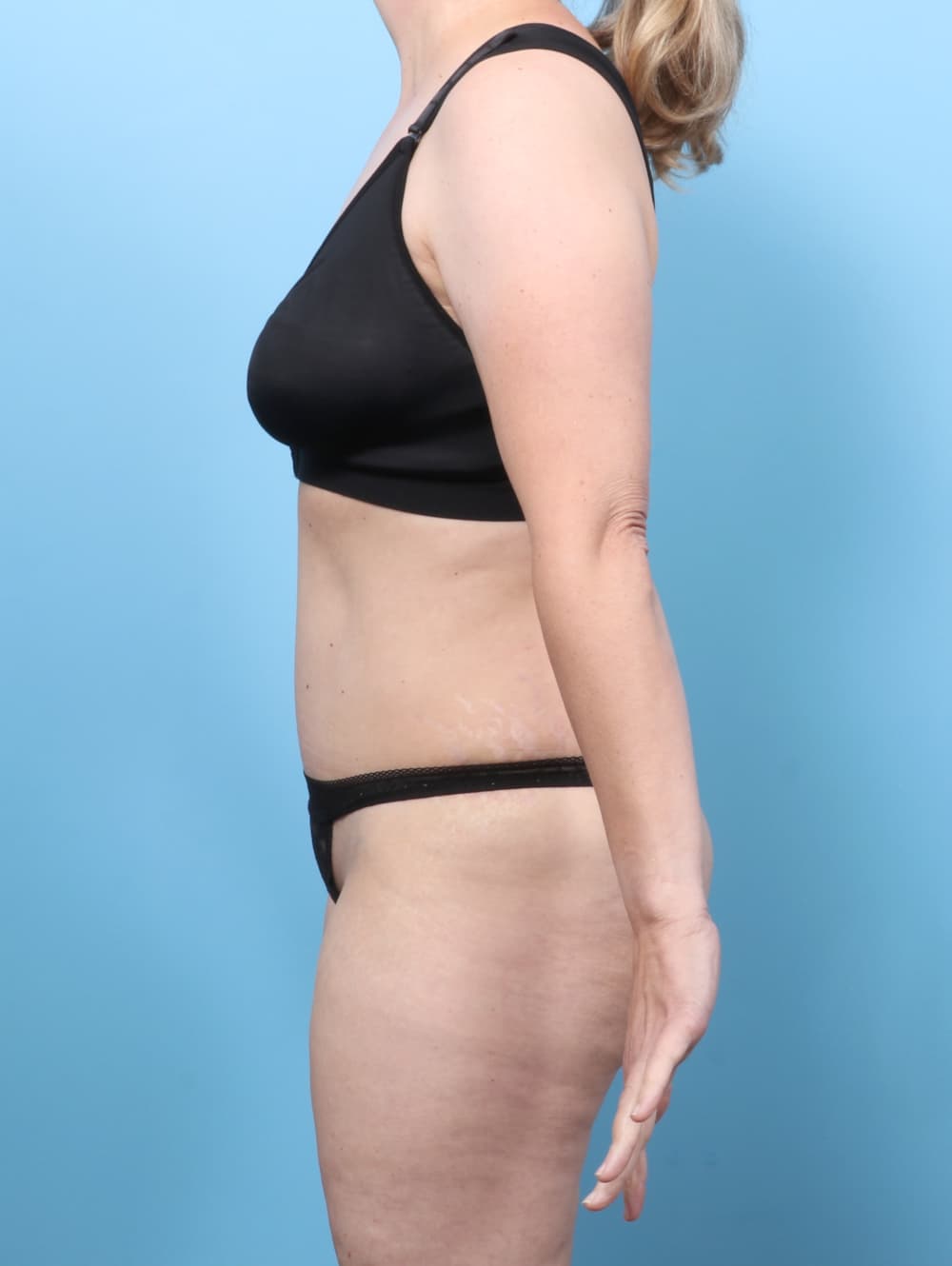 Tummy Tuck case #8634 after, image 3