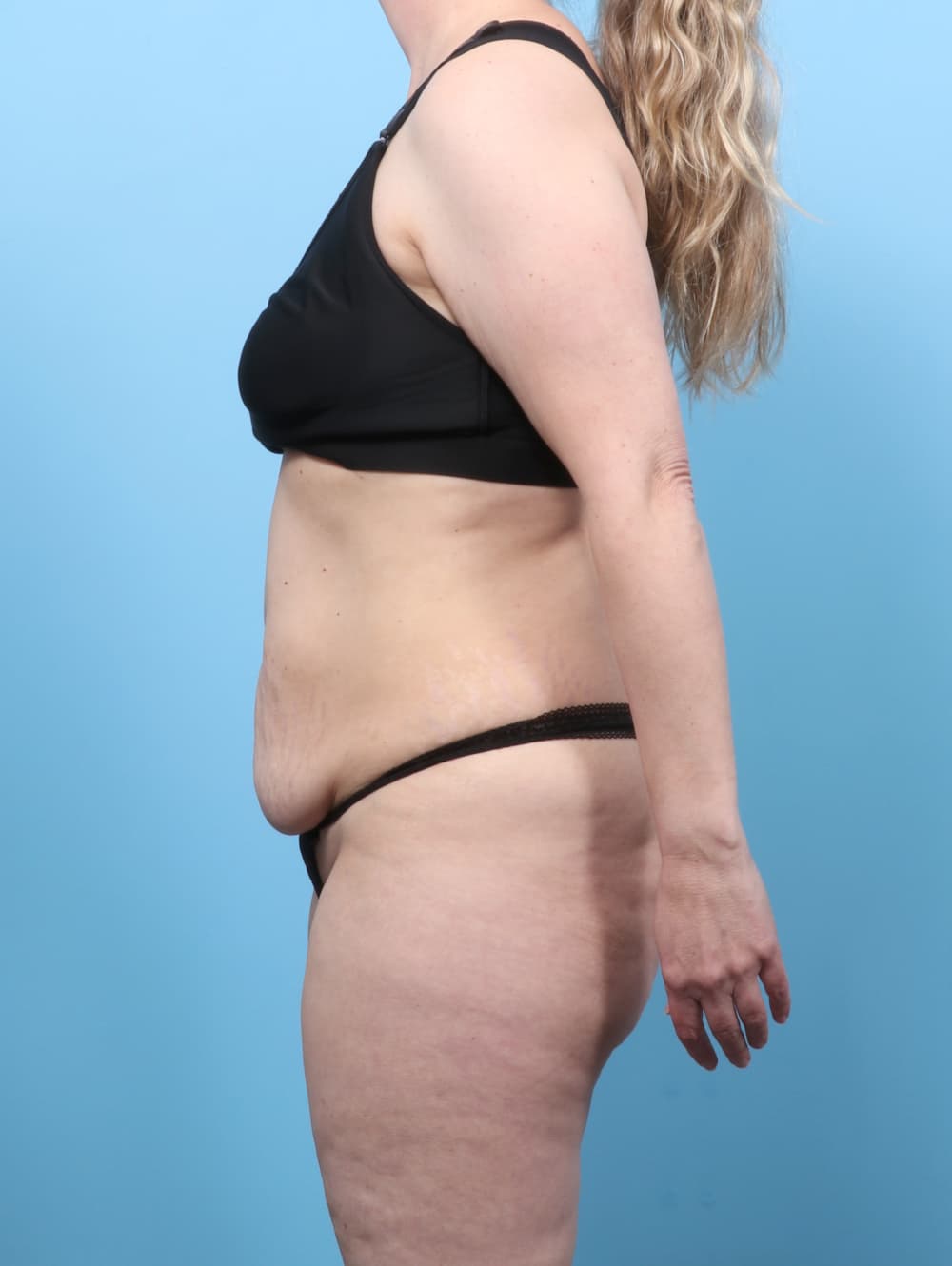 Tummy Tuck case #8634 before, image 3