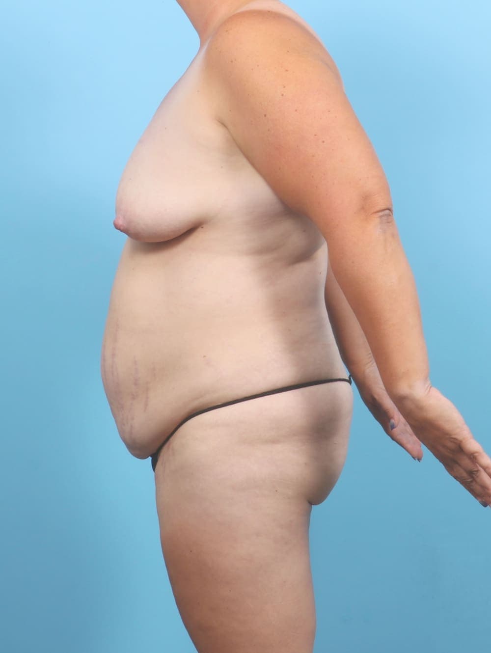 Tummy Tuck case #6707 before, image 3