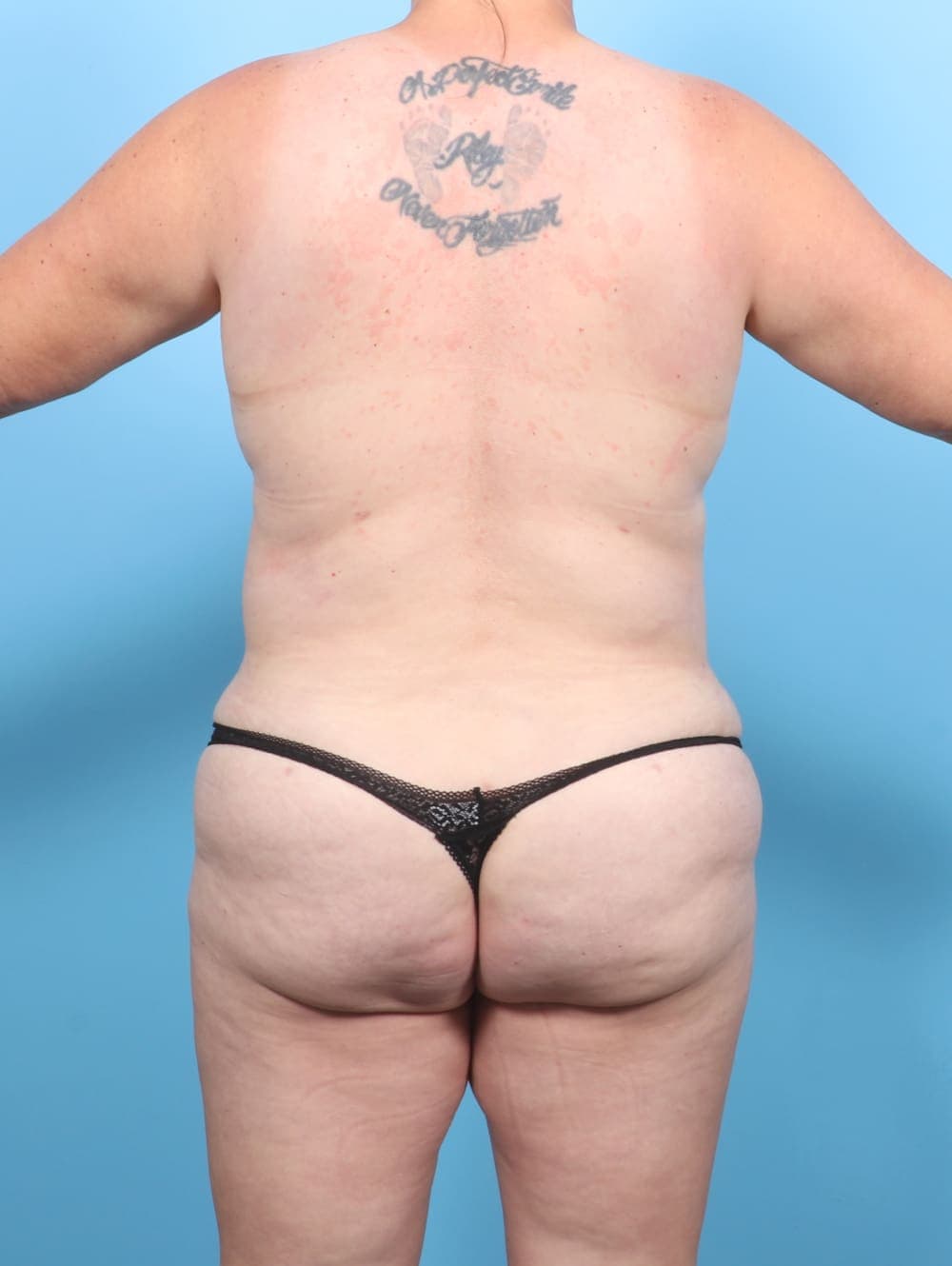 Tummy Tuck case #6707 after, image 4