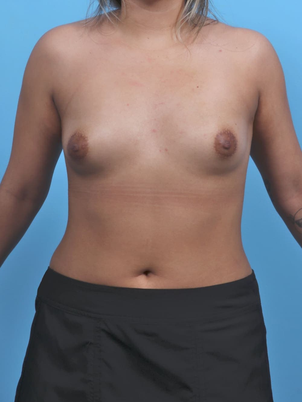Breast Augmentation case #5968 before, image 1