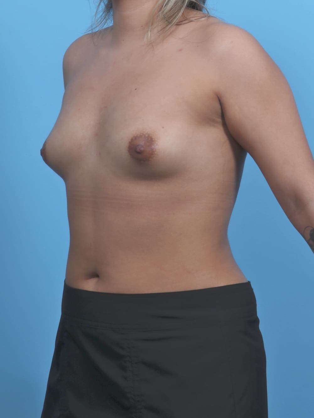 Breast Augmentation case #5968 before, image 2
