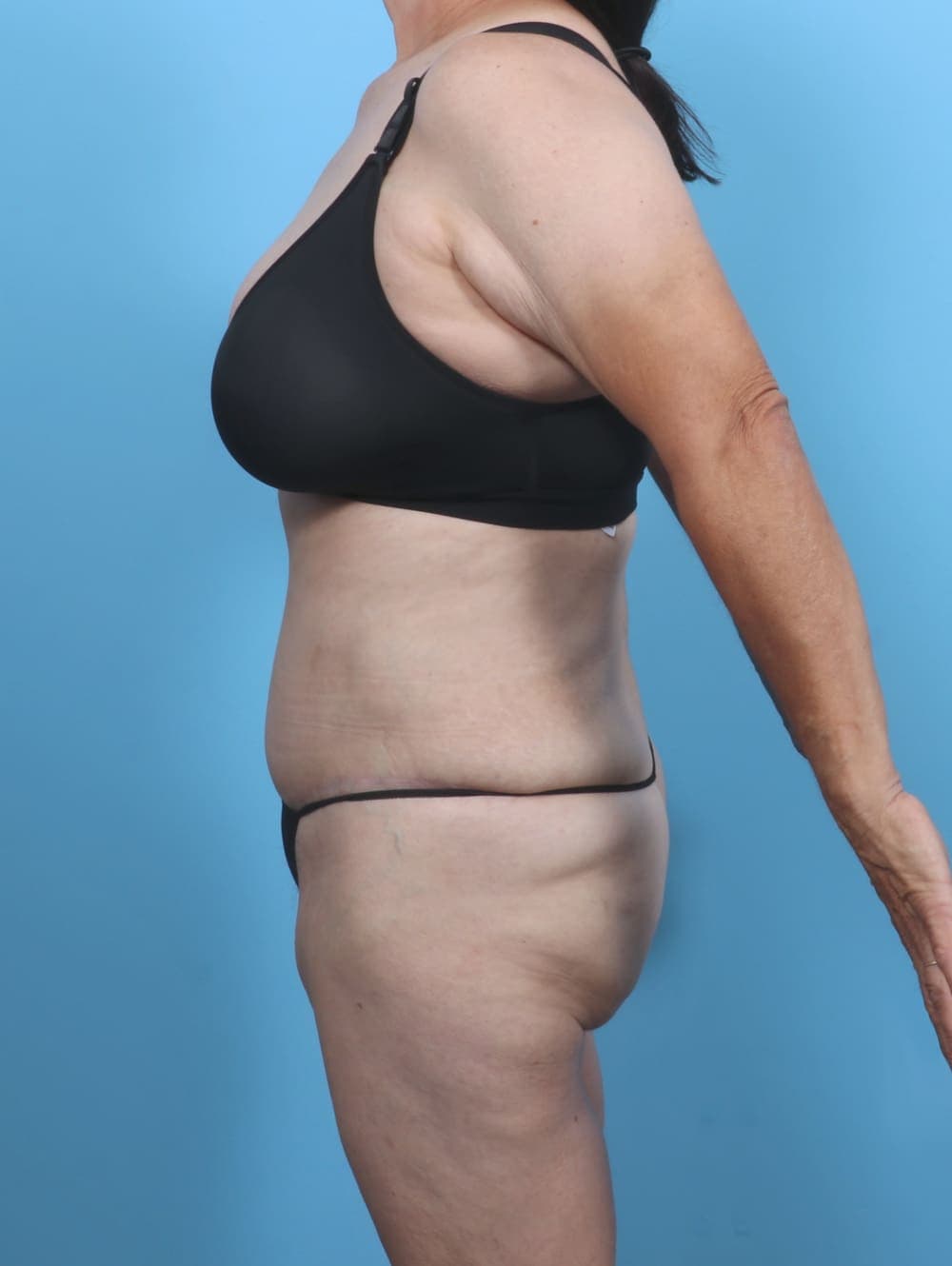 Liposuction case #5763 after, image 3