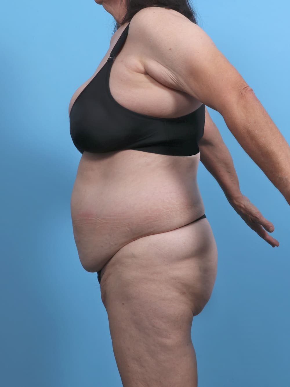 Liposuction case #5763 before, image 3