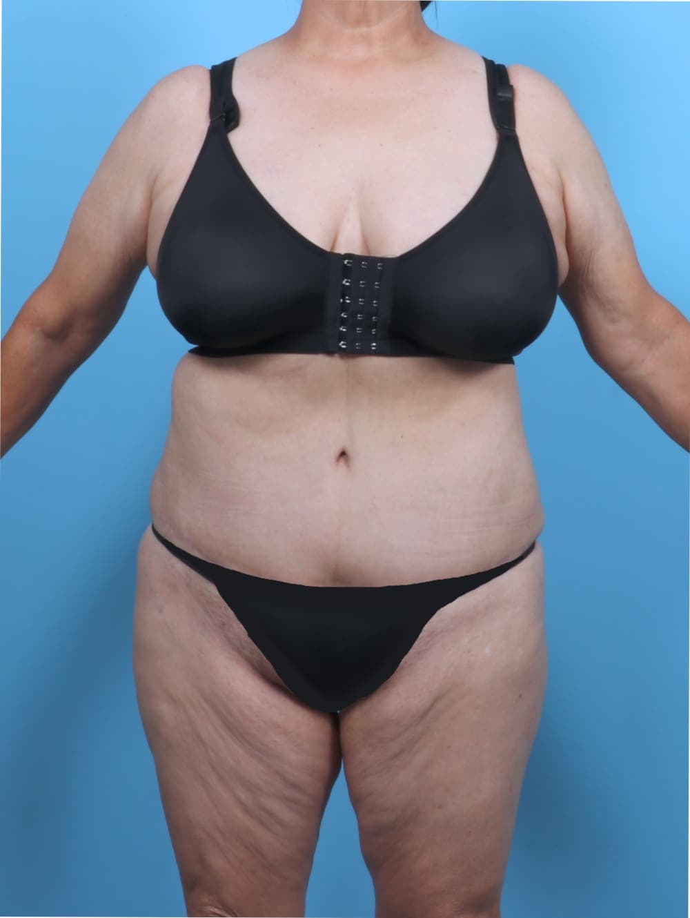 Liposuction case #5763 after, image 1