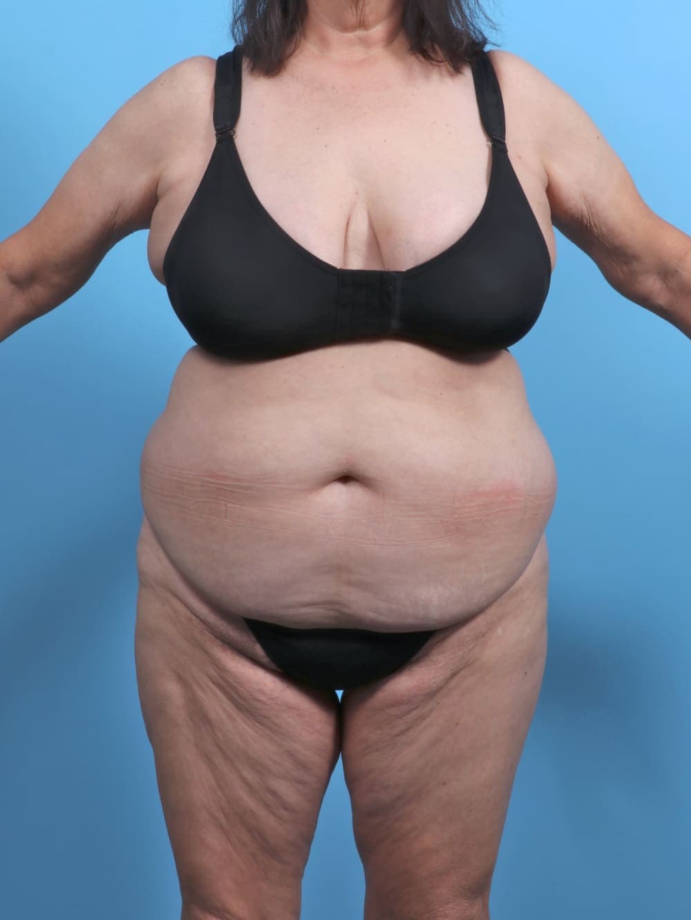 Liposuction case #5763 before, image 1