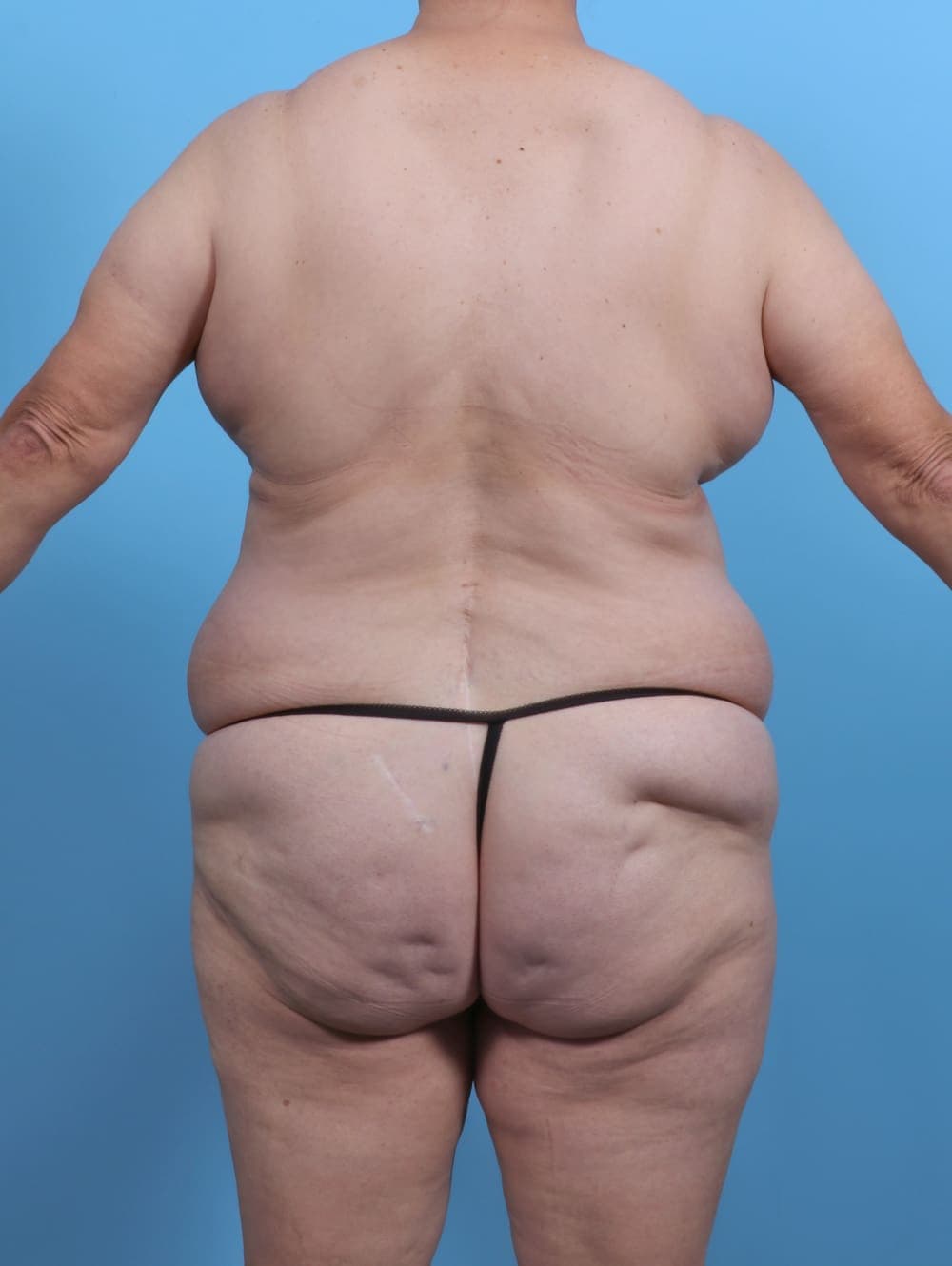 Liposuction case #5763 before, image 4