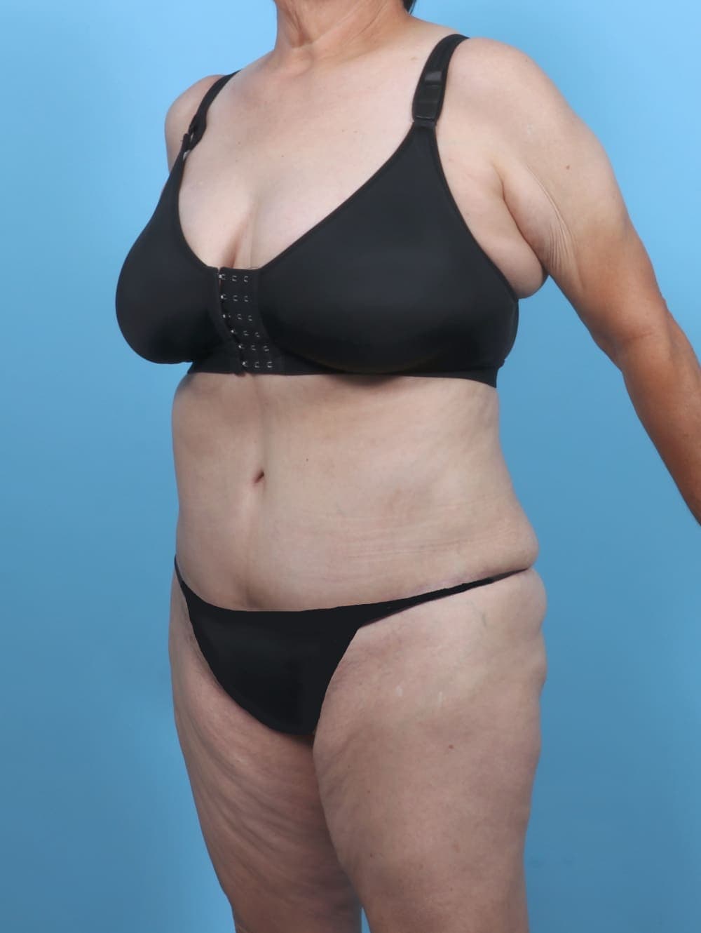 Liposuction case #5763 after, image 2