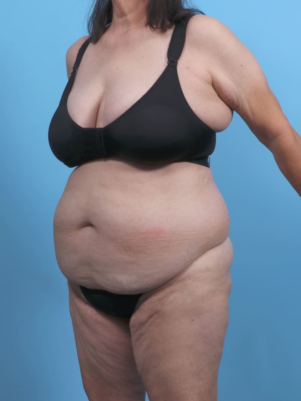 Liposuction case #5763 before, image 2