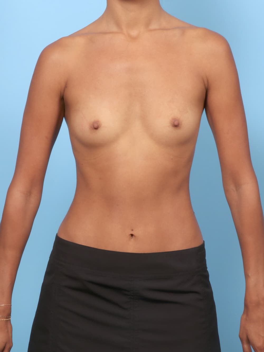 Breast Augmentation case #8836 before, image 1
