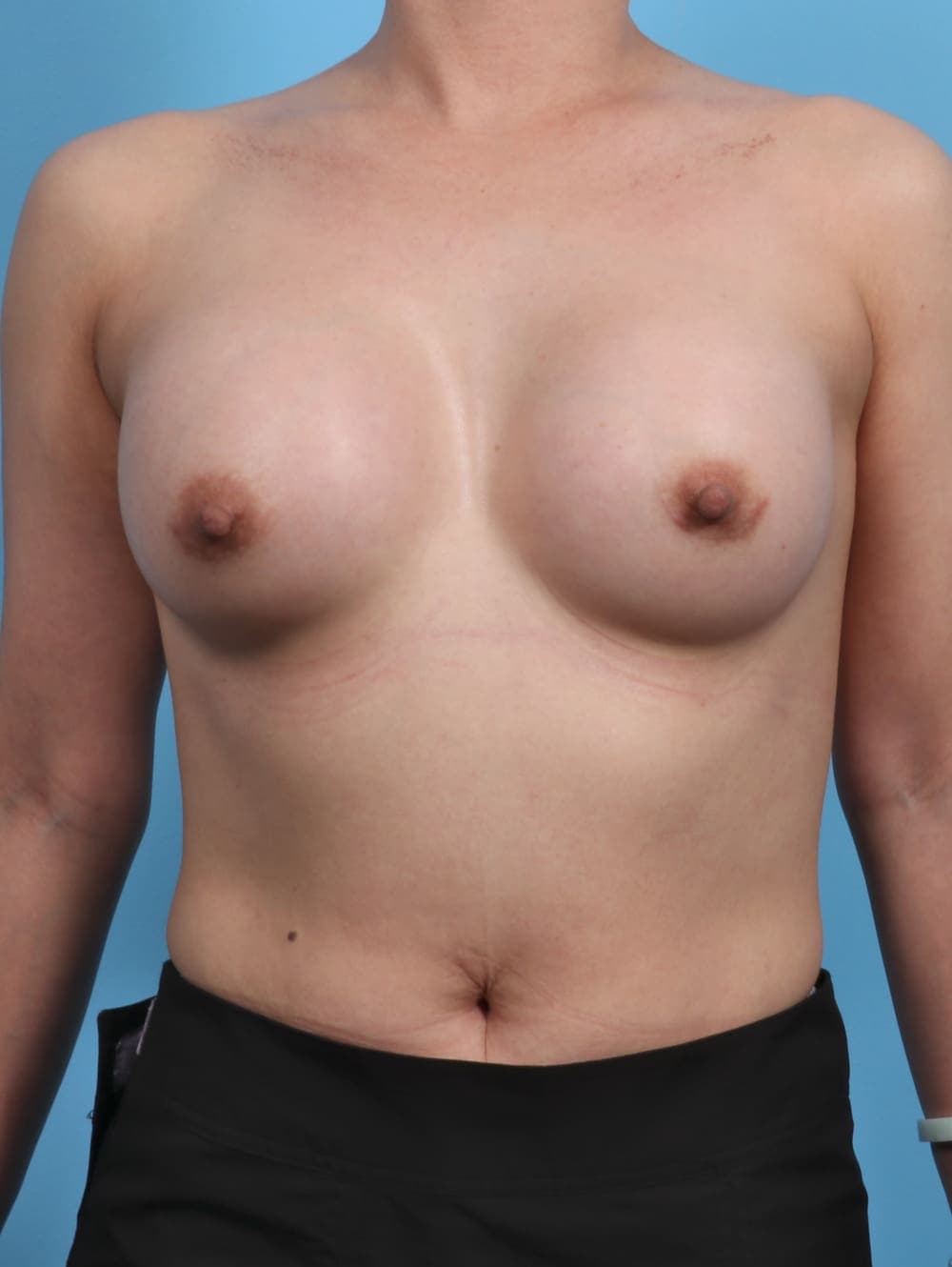 Breast Augmentation case #3779 after, image 1