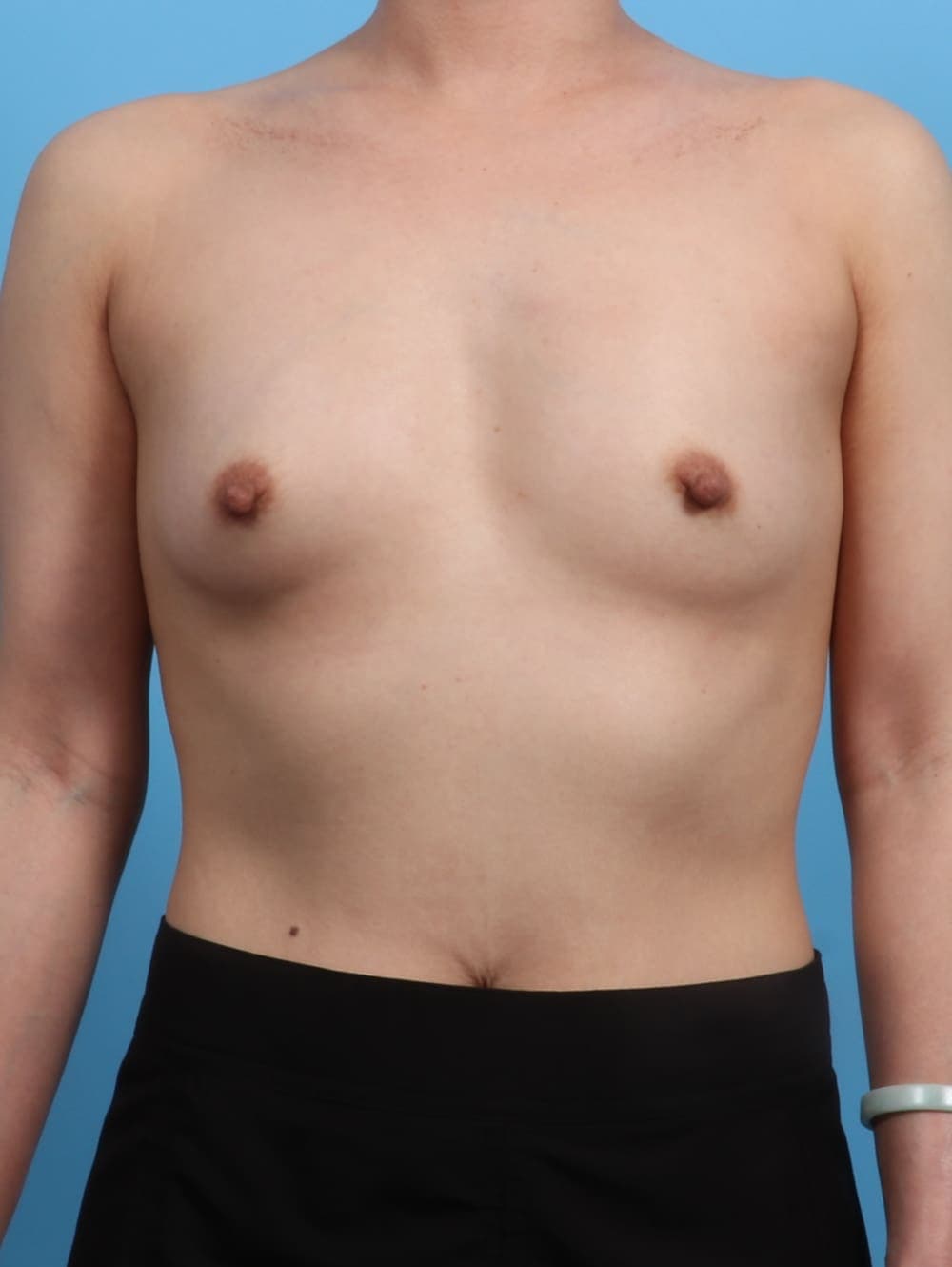Breast Augmentation case #3779 before, image 1