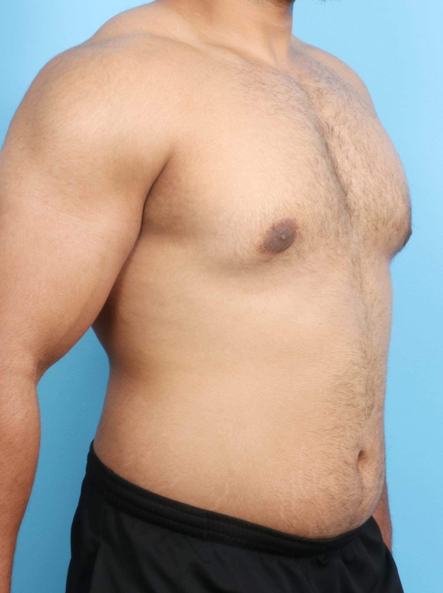 Male Breast Reduction case #1684 after, image 3