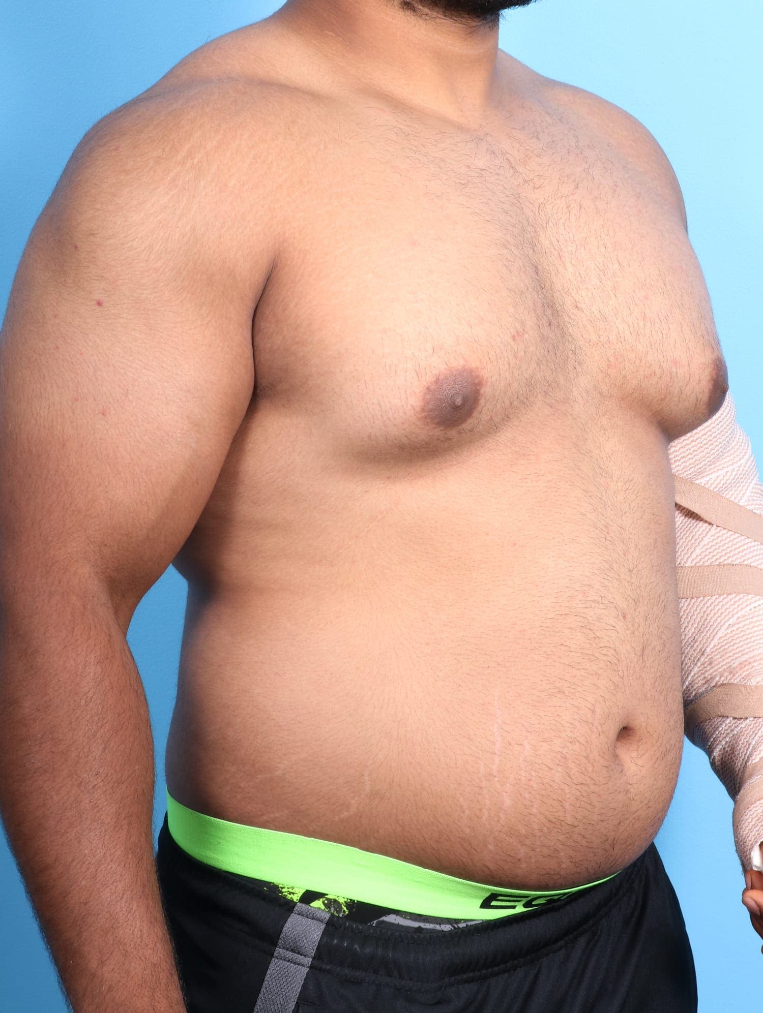 Male Breast Reduction case #1684 before, image 3