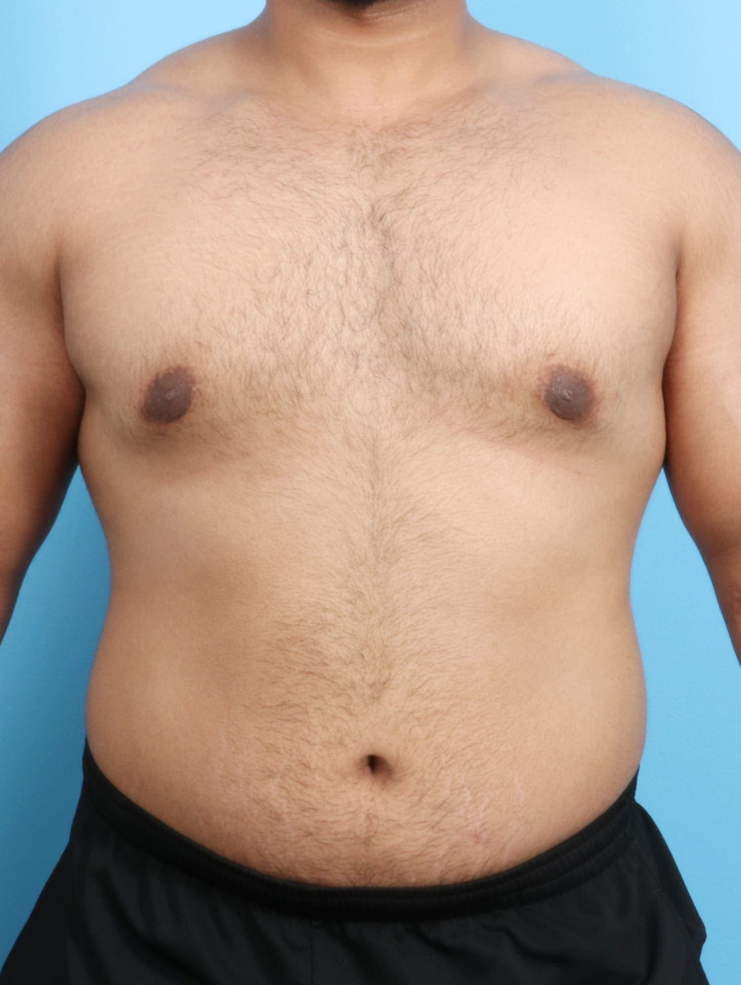 Male Breast Reduction case #1684 after