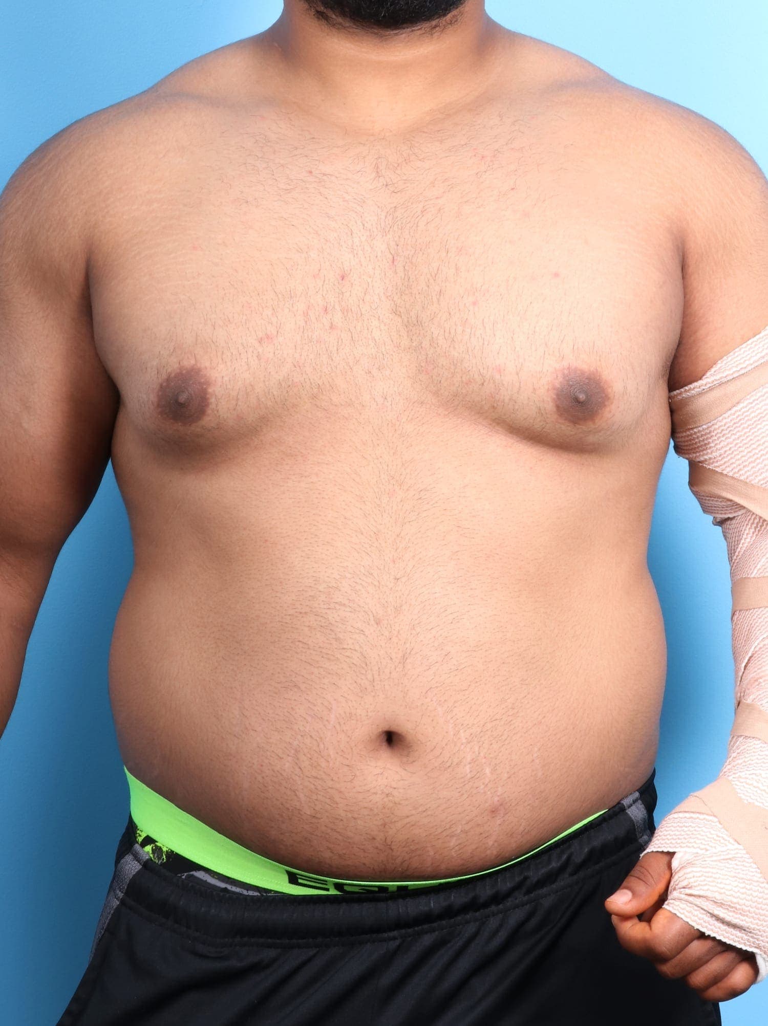 Male Breast Reduction case #1684 before