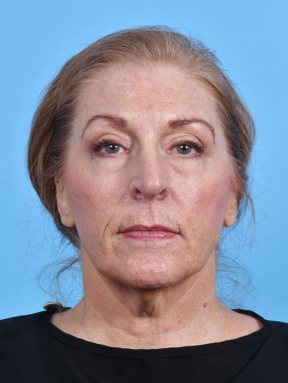Facelift case #3641 before, image 1