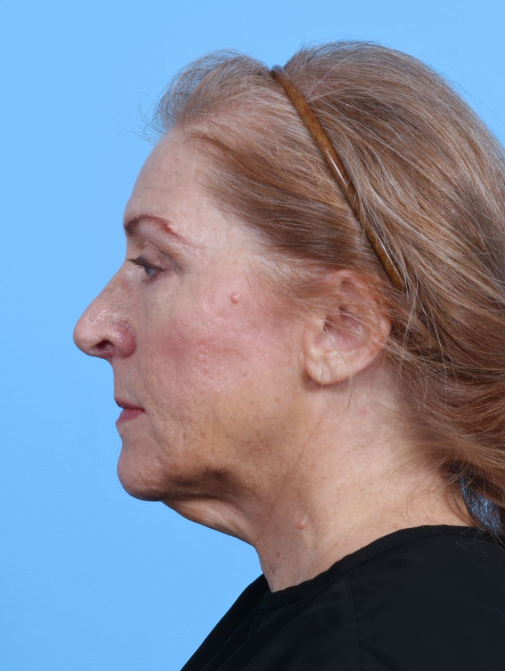 Facelift case #3641 before, image 3