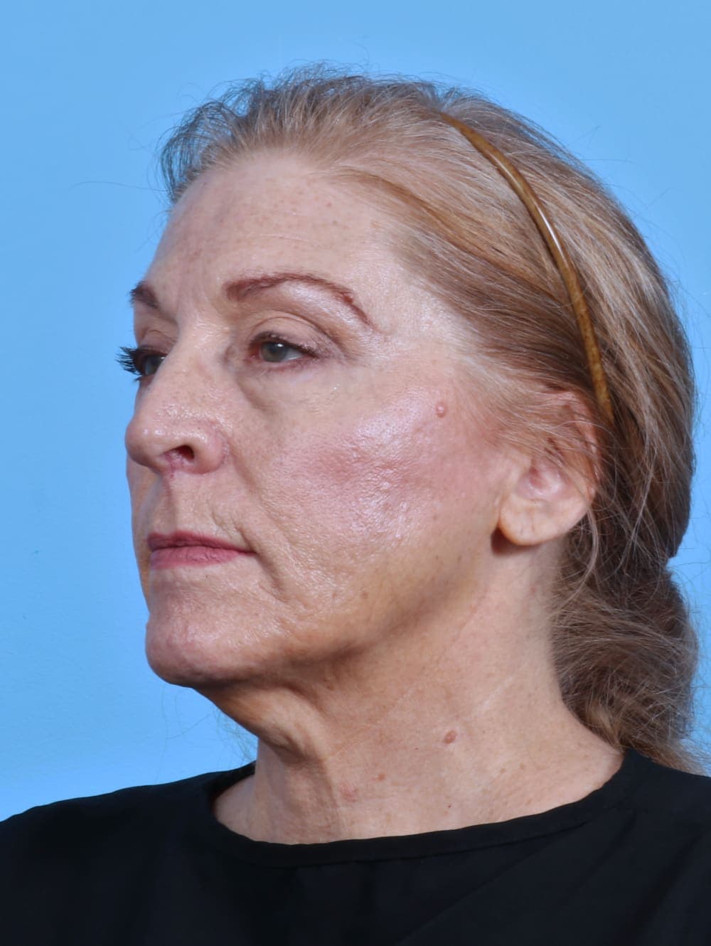 Facelift case #3641 before, image 2