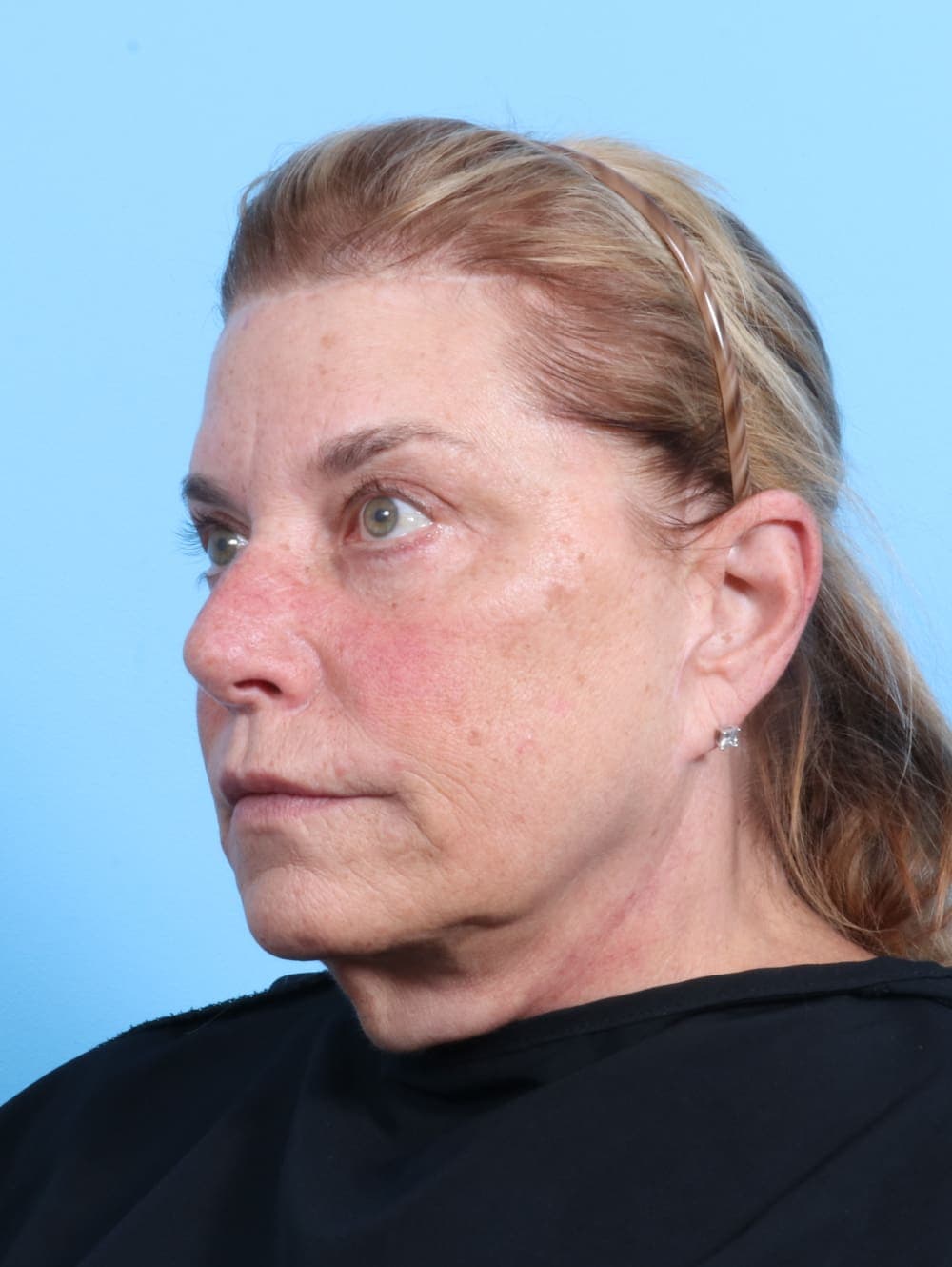 Facelift case #1973 after, image 2