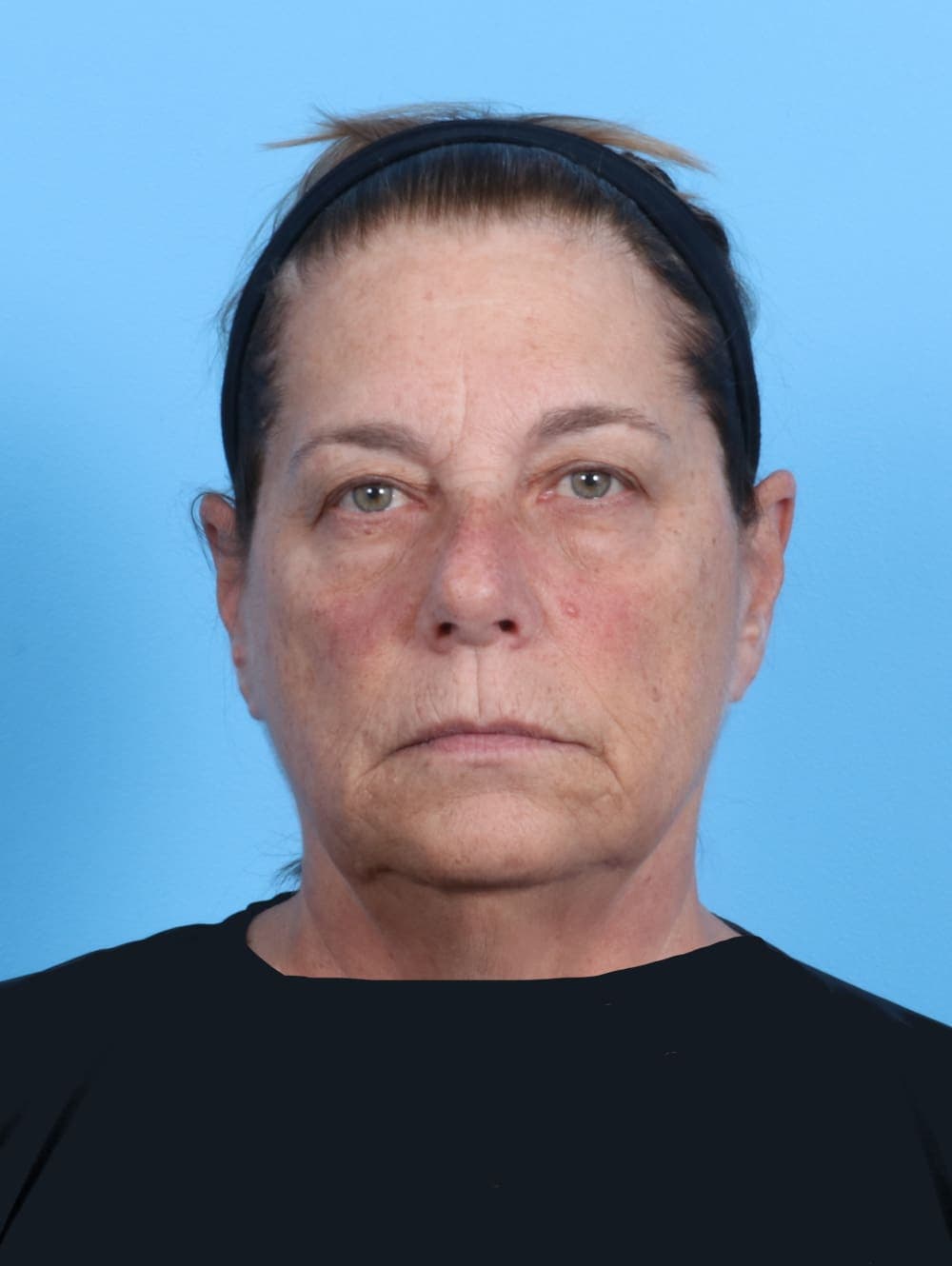 Facelift case #1973 before, image 1