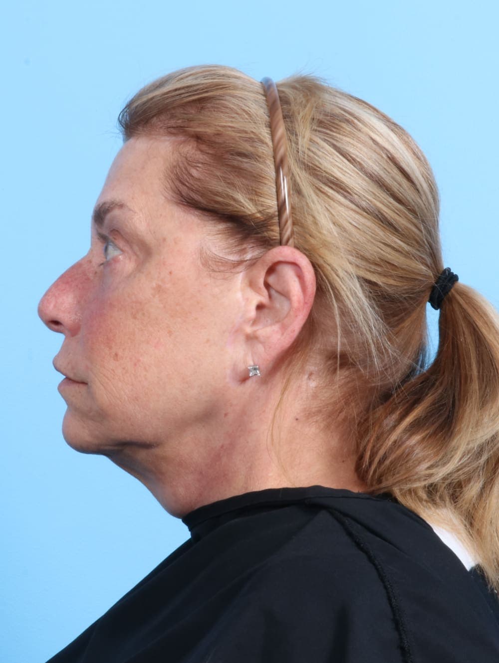 Facelift case #1973 after, image 3