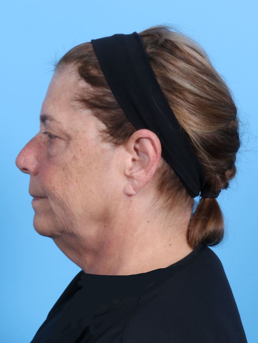 Facelift case #1973 before, image 3