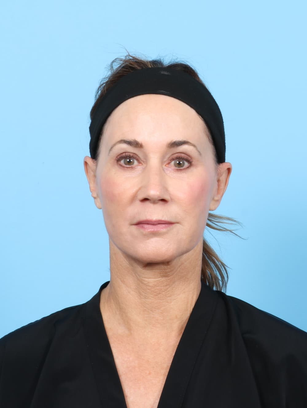 Eyelid Surgery case #7313 after