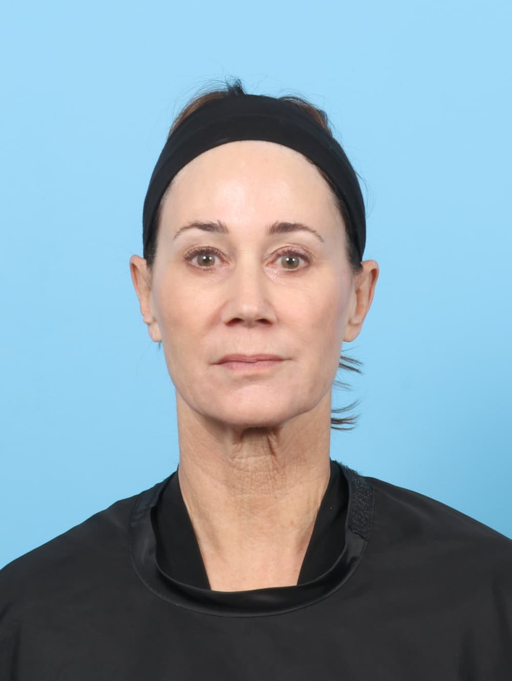 Eyelid Surgery case #7313 before