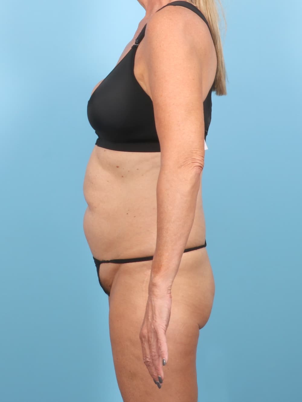 Tummy Tuck case #8378 before, image 3