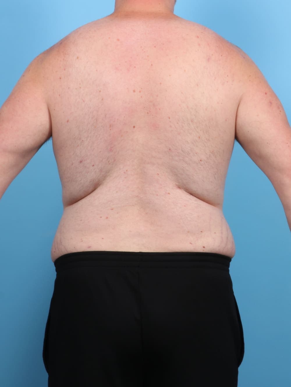 Liposuction case #5542 after, image 2