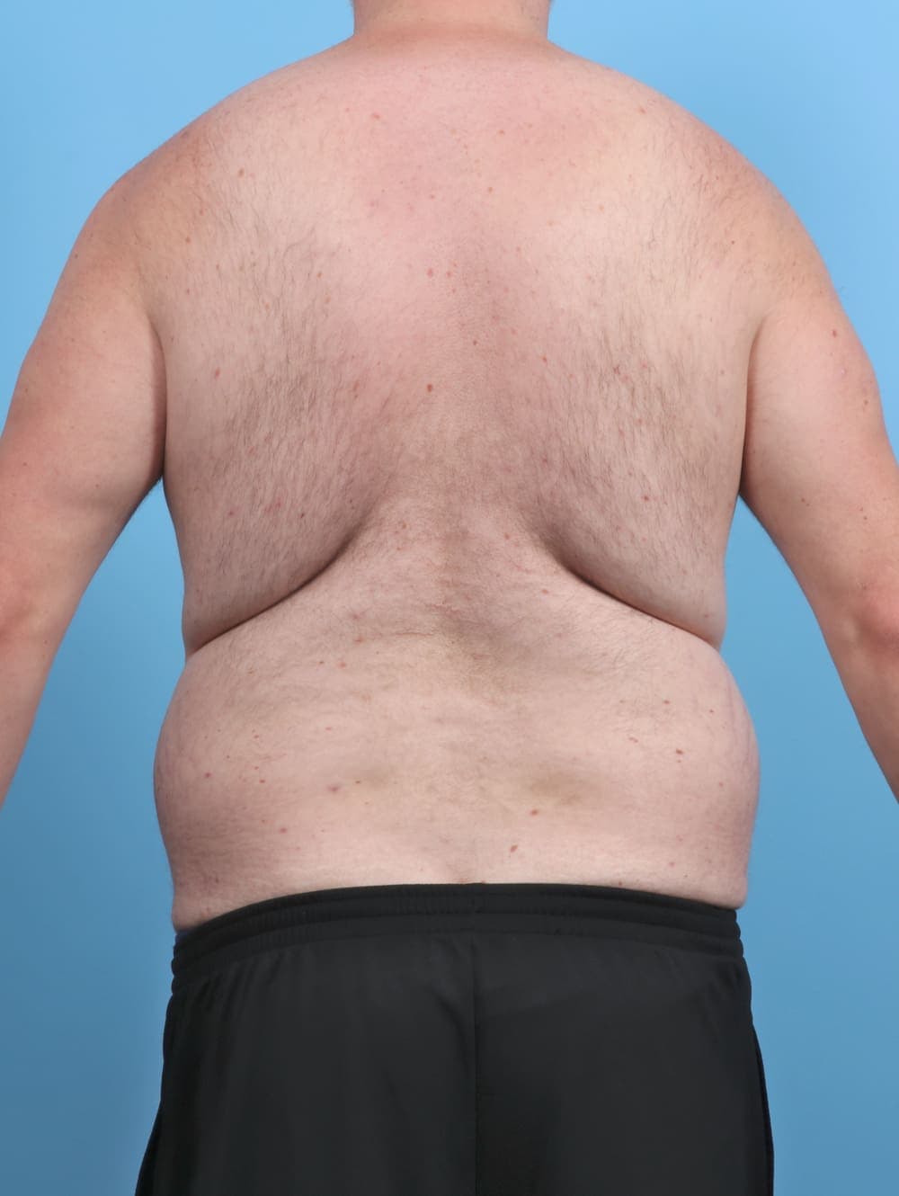 Liposuction case #5542 before, image 2