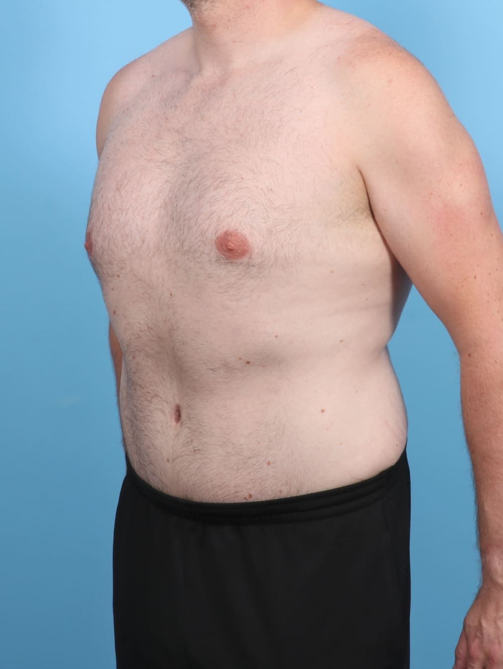 Liposuction case #5542 after, image 3