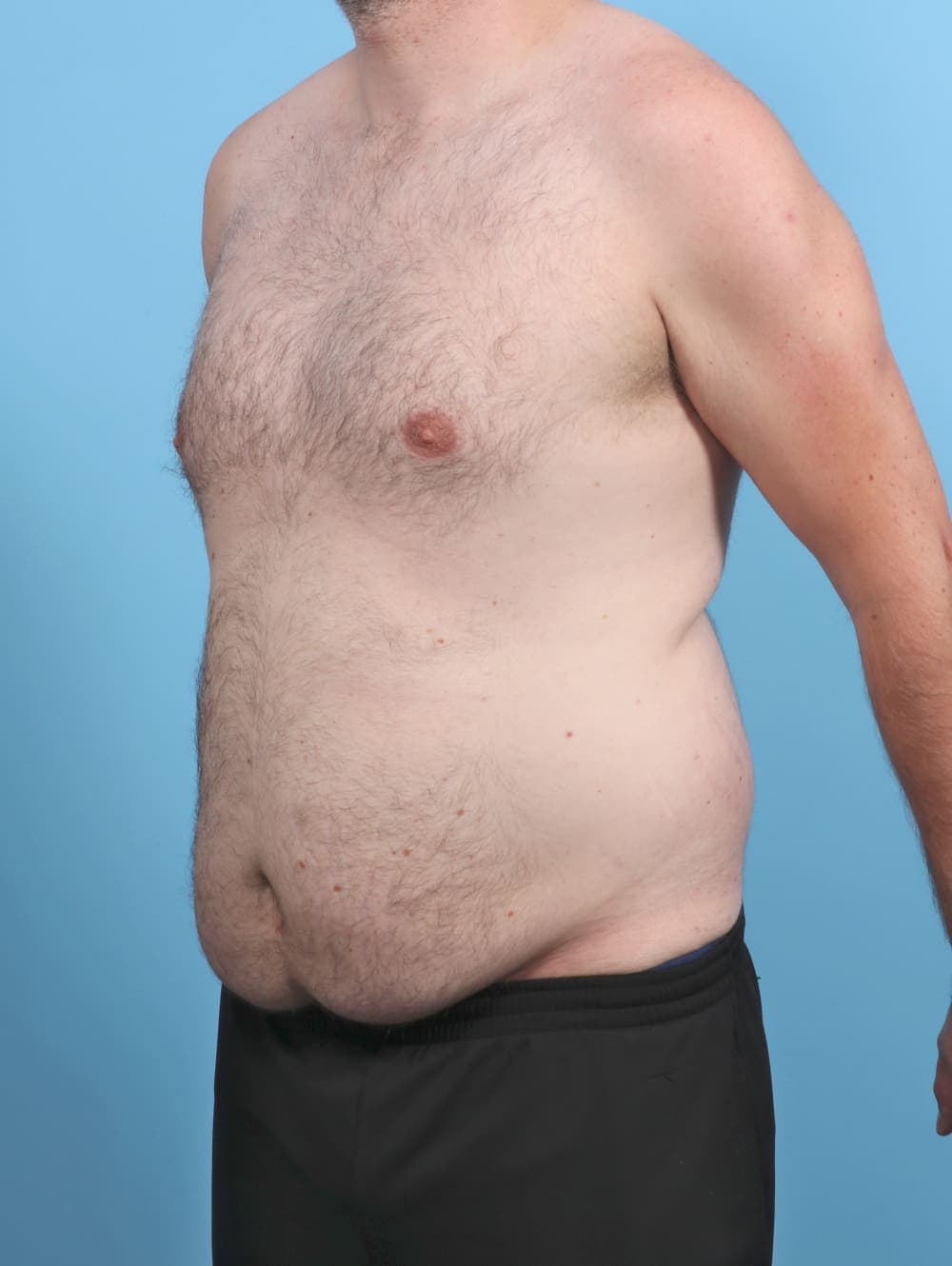 Liposuction case #5542 before, image 3
