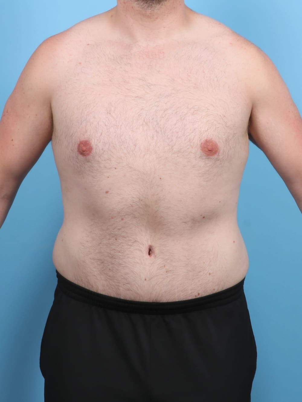 Liposuction case #5542 after, image 1