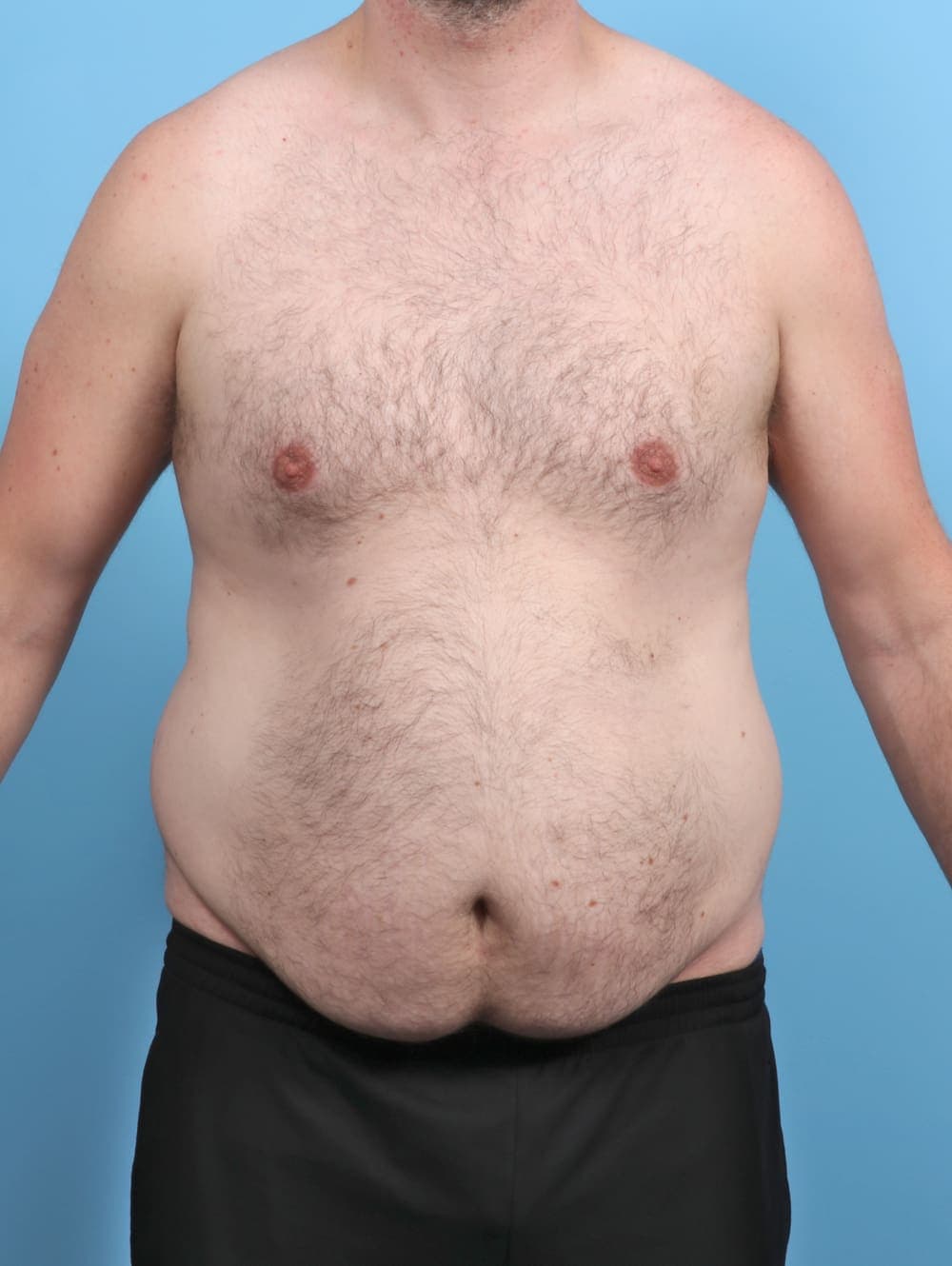 Liposuction case #5542 before, image 1