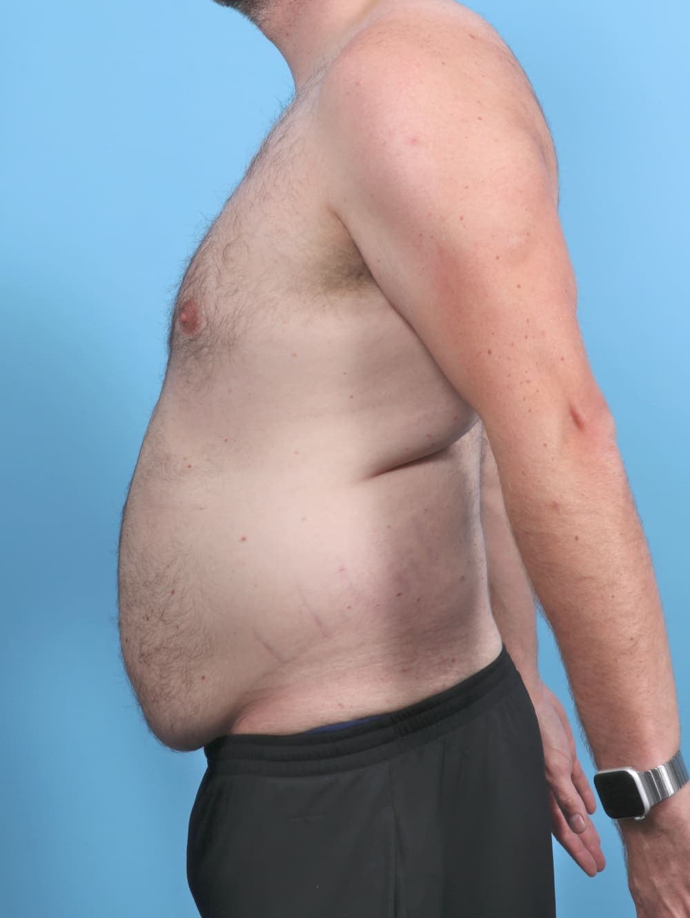 Liposuction case #5542 before, image 4