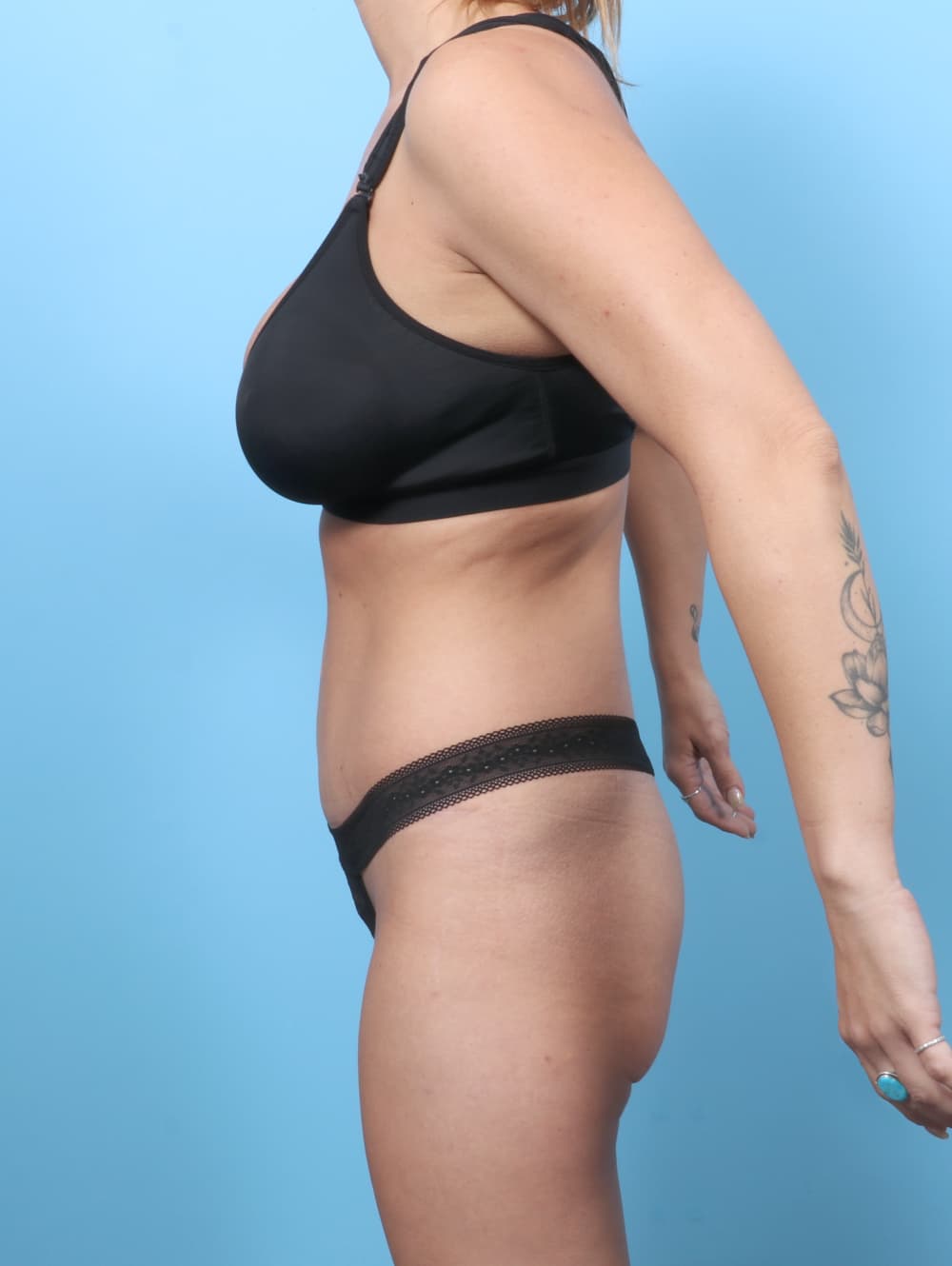 Tummy Tuck case #8730 after, image 3