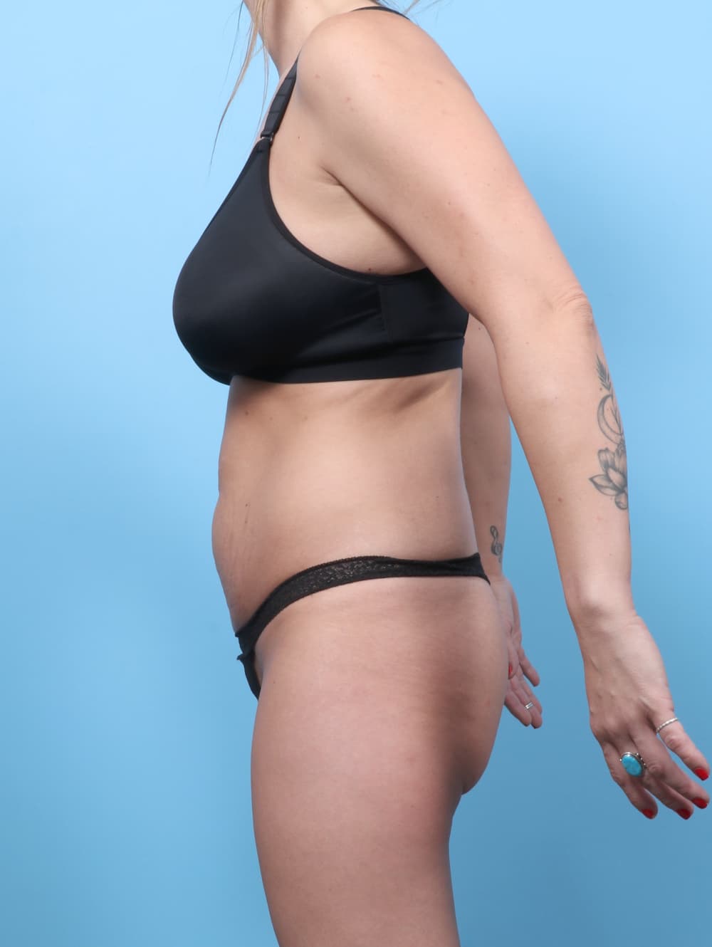 Tummy Tuck case #8730 before, image 3