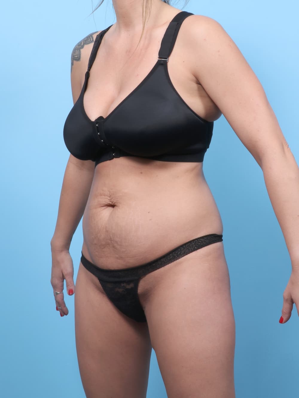 Tummy Tuck case #8730 before, image 2