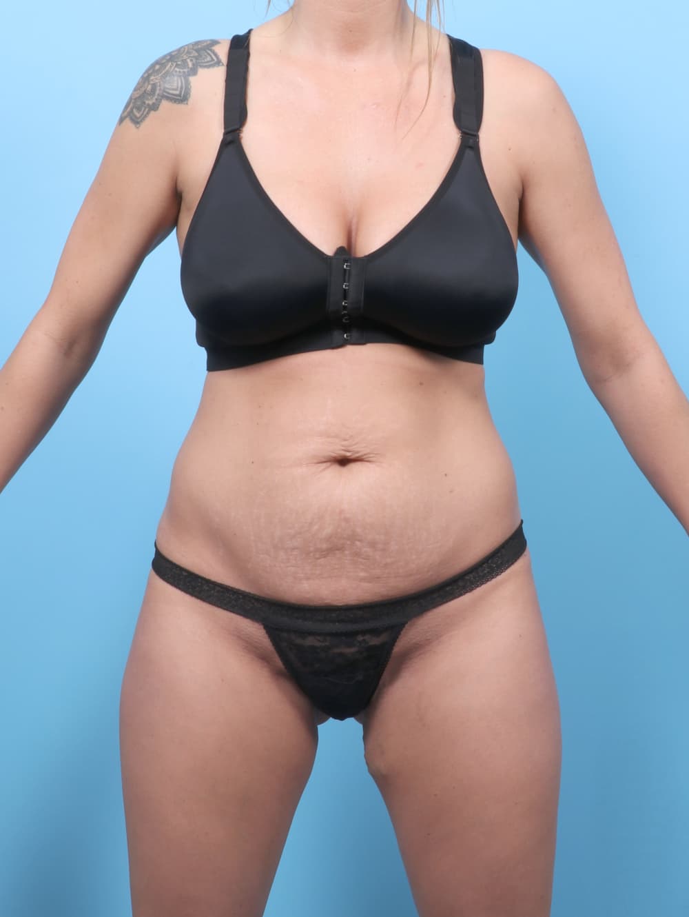 Tummy Tuck case #8730 before