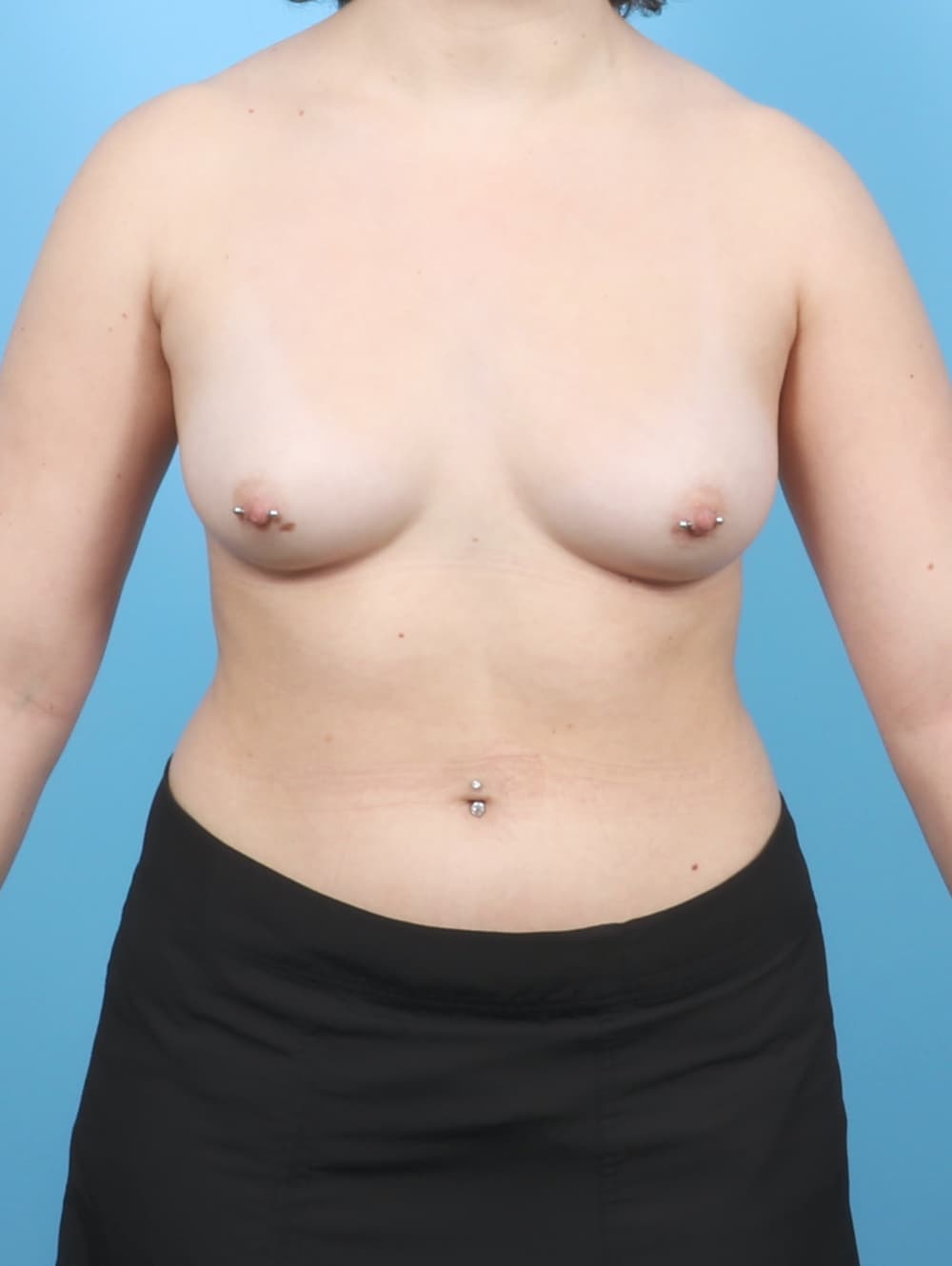 Breast Augmentation case #7070 before, image 1