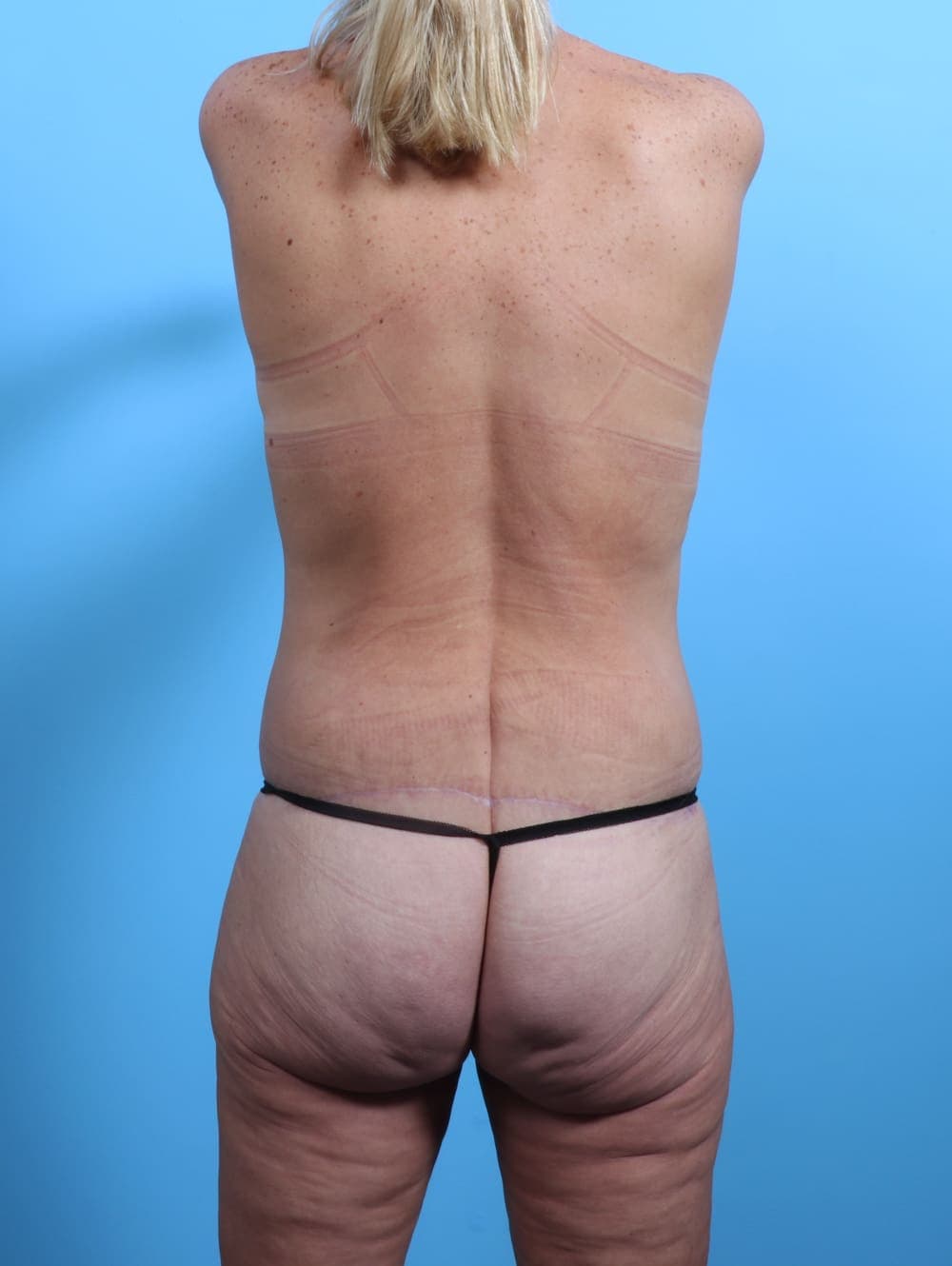 Body Lift case #3052 after, image 2