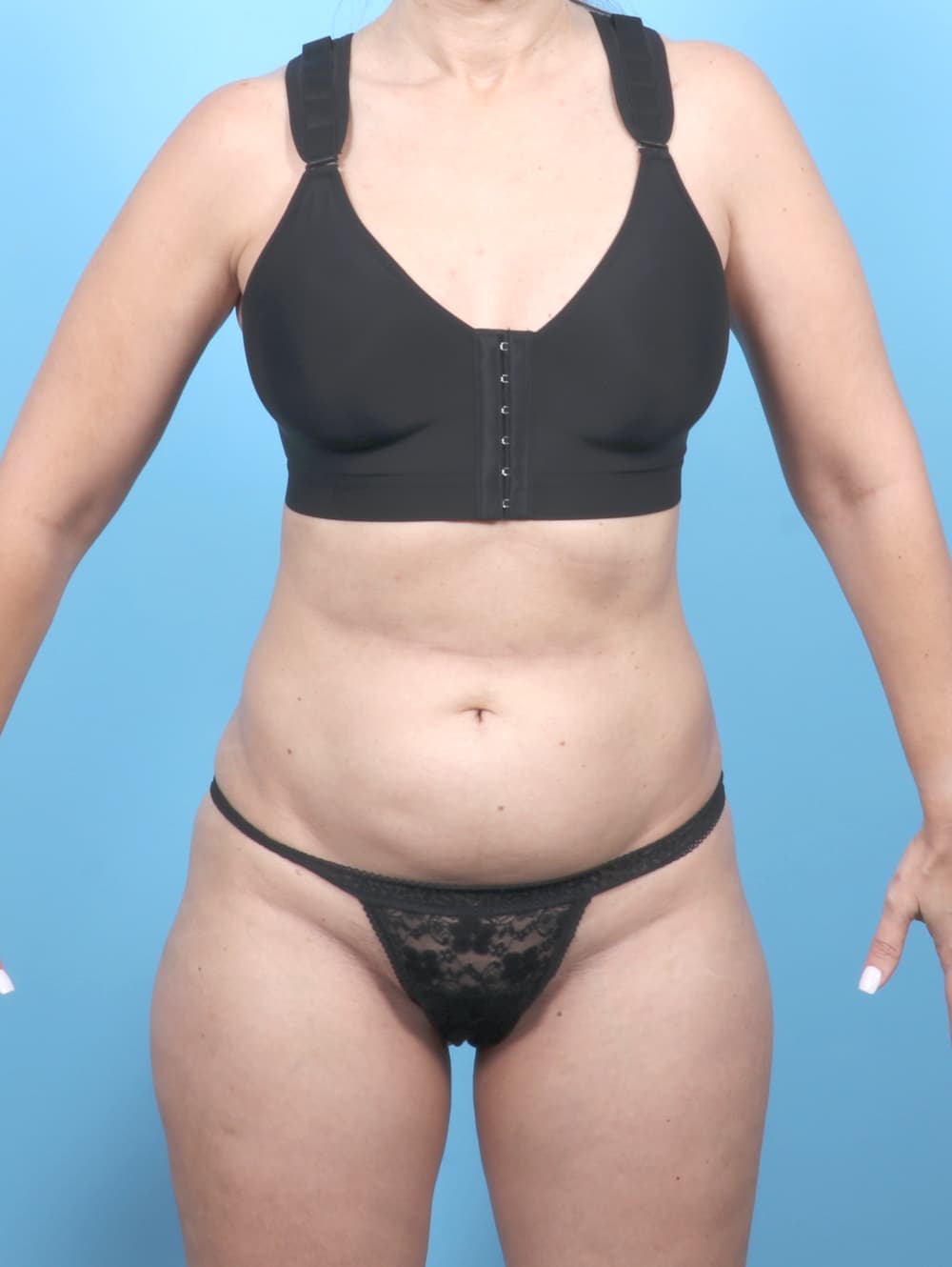 Tummy Tuck case #7054 before, image 1