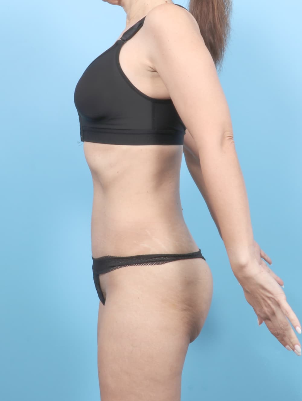 Tummy Tuck case #7054 after, image 3