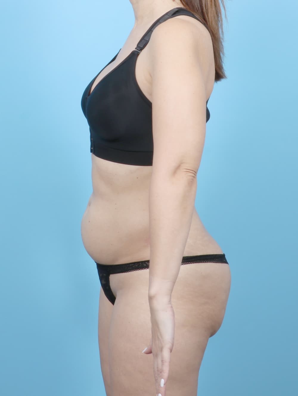 Tummy Tuck case #7054 before, image 3